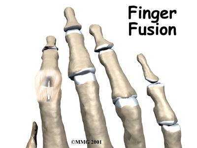 Finger Fusion Surgery - R.P.T Physical Therapy's Guide