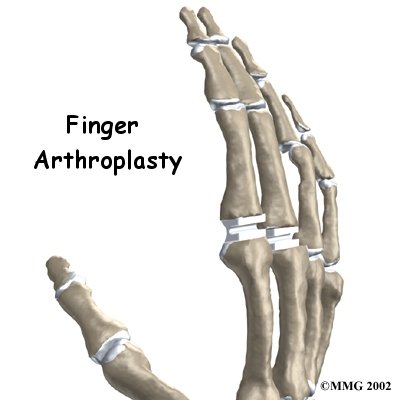 Artificial Joint Replacement of the Finger - R.P.T Physical Therapy's Guide